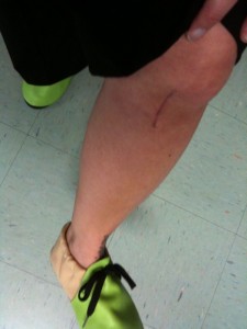 Jane's scar